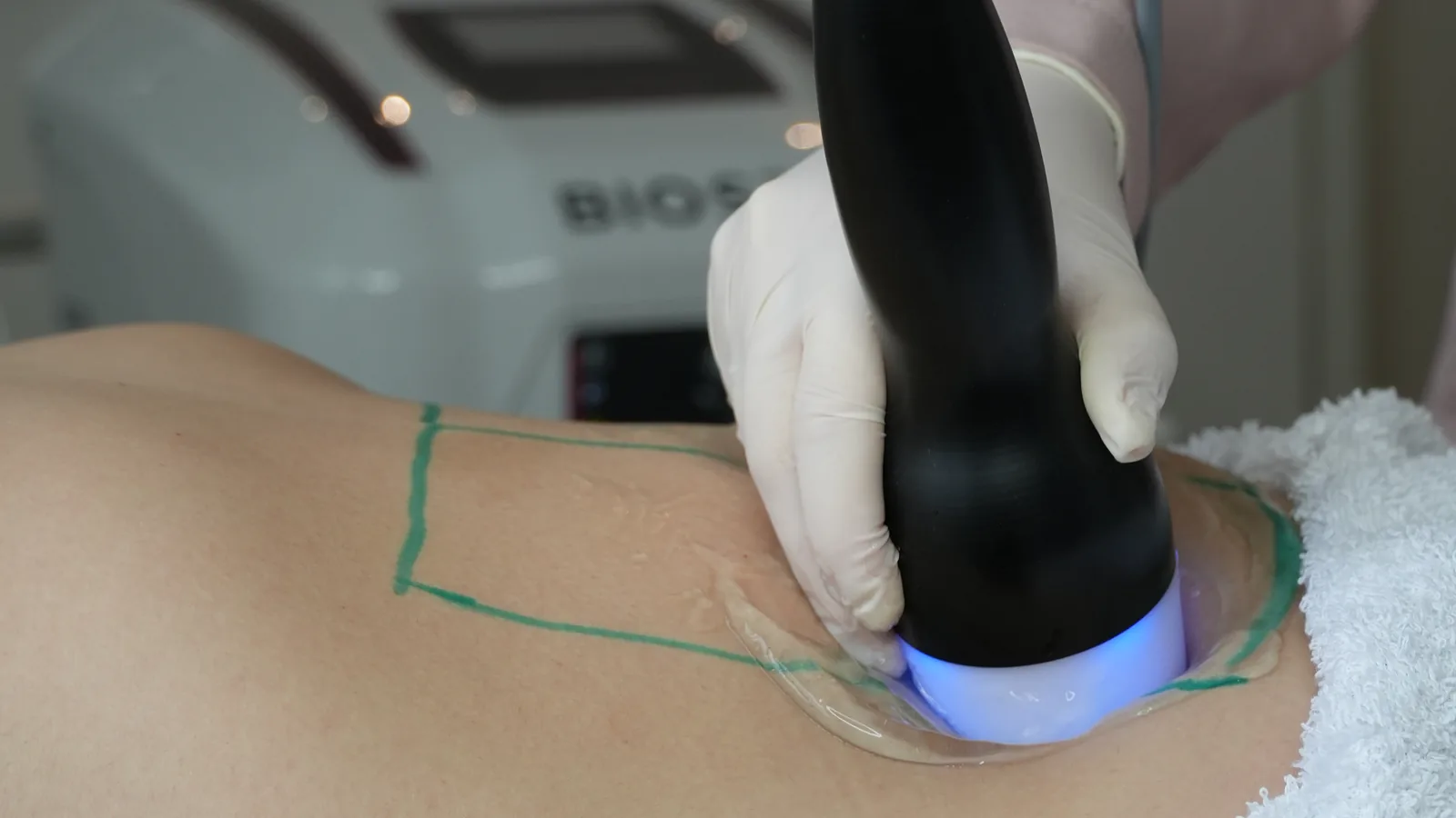 Transdutor do Cavitouch com anel de luz azul sobre gel em área demarcada do abdome, com o aparelho desfocado ao fundo