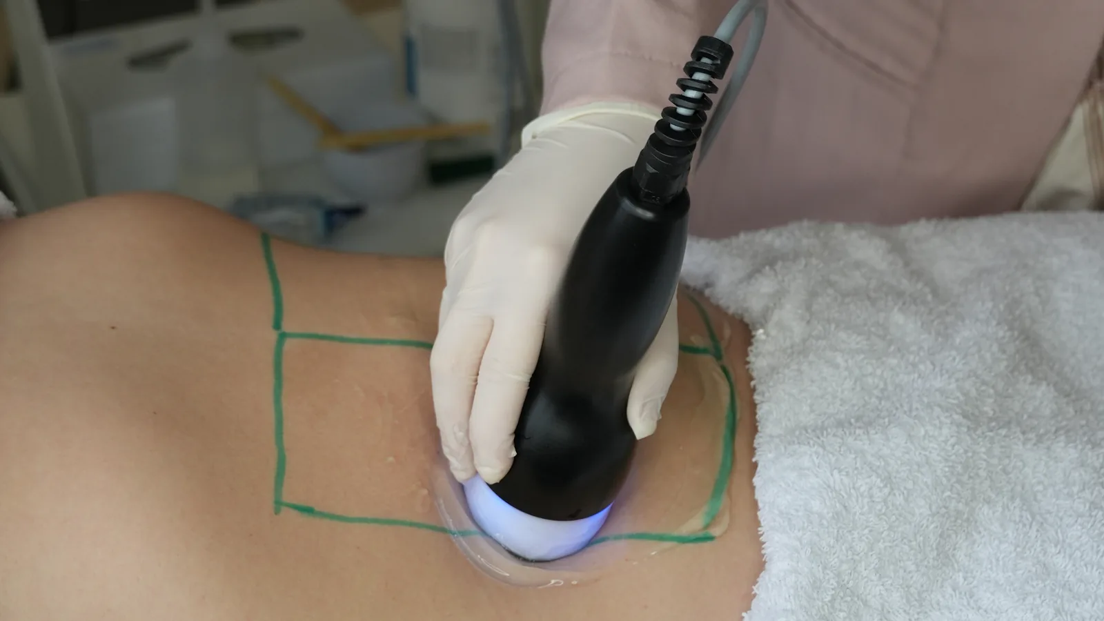 Mão com luva apoia o transdutor do Cavitouch sobre gel na lateral do abdome, dentro de quadrados demarcados em verde
